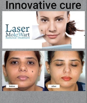 benefites of laser mole removal